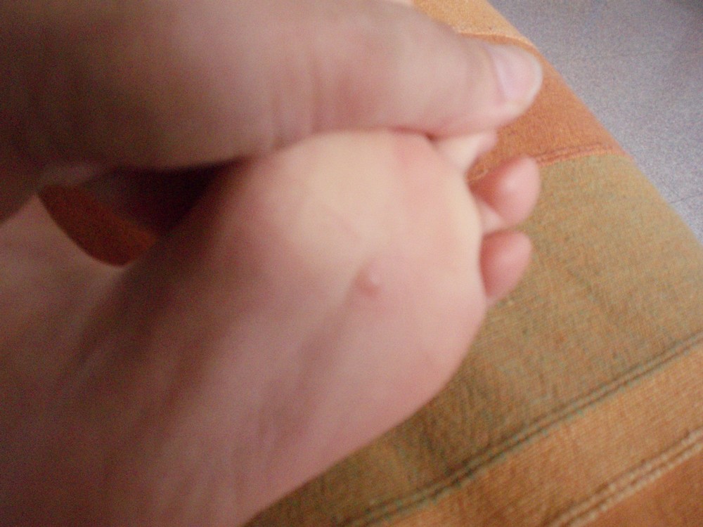 petit bouton sous les pieds petit bouton sous les pieds